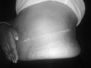 Vicky's partial nephrectomy scar.